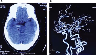 Hemorrhagic schwannoma of the trochlear nerve: Case report and a review of the literature